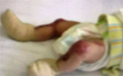 女婴罕见皮肤缺失鲜血淋淋  全球患病率仅有十万分之一