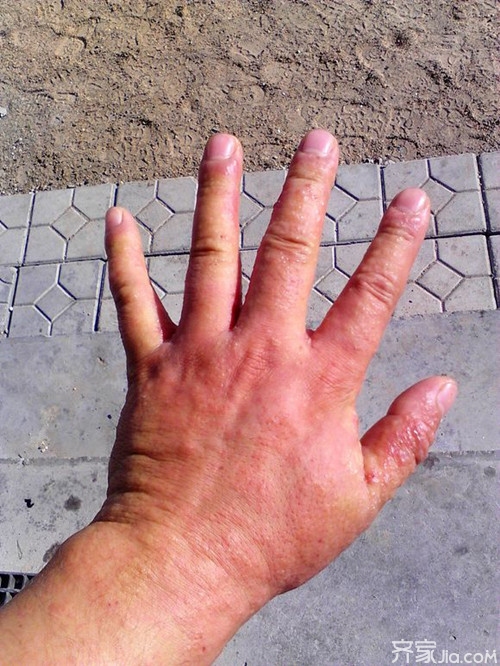 生漆过敏怎么办 针对生漆过敏的十大对策