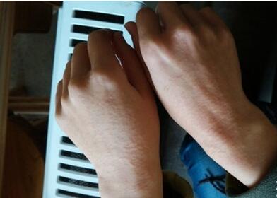 生漆过敏怎么办  生漆过敏四大应对措施分享