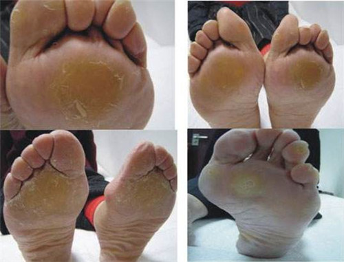 脚垫怎么治疗有效 6种方法教你完美治疗各种脚垫